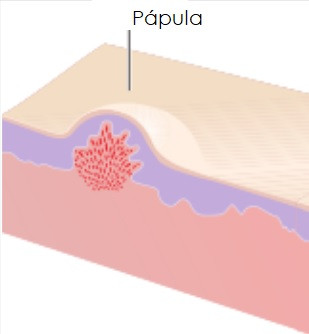 Pápula